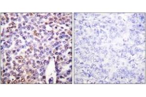 Immunohistochemistry analysis of paraffin-embedded human breast carcinoma tissue, using Histone H4 (Ab-16) Antibody. (Histone H4 Antikörper  (AA 15-64))