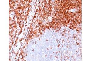 IHC testing of formalin-paraffin non-Hodgkin's lymphoma stained with Bcl-2 antibody (100/D5). (Bcl-2 Antikörper)