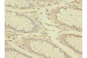 Immunohistochemistry of paraffin-embedded human colon cancer using ABIN7172869 at dilution of 1:100 (TRPM7 Antikörper  (AA 756-855))