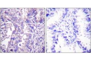 Immunohistochemistry analysis of paraffin-embedded human lung carcinoma tissue, using GAD1/2 Antibody. (GAD65+GAD67 (AA 545-594) Antikörper)