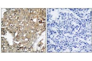 Immunohistochemical analysis of paraffin-embedded human breast carcinoma tissue using STAT1 (Ab-727) antibody (E021177). (STAT1 Antikörper)