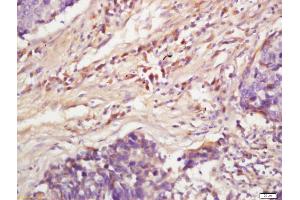 Formalin-fixed and paraffin embedded human lung carcinoma labeled with Anti-Phospho-MAPKAPK2(Ser272)Polyclonal Antibody, Unconjugated (ABIN710531) at 1:200, followed by conjugation to the secondary antibody and DAB staining (MAPKAP Kinase 2 Antikörper  (pSer272))