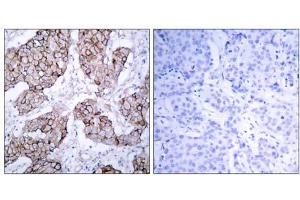 Immunohistochemical analysis of paraffin- embedded human breast carcinoma tissue using (EGFR Antikörper  (pTyr1092))