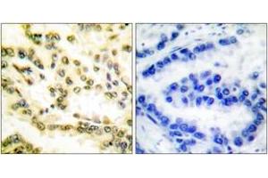 Immunohistochemistry analysis of paraffin-embedded human lung carcinoma tissue, using Lamin A (Cleaved-Asp230) Antibody. (Lamin A/C Antikörper  (Cleaved-Asp230))