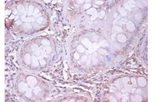 Immunohistochemistry of paraffin-embedded human colon cancer using ABIN7144046 at dilution of 1:100 (APP Antikörper  (AA 18-664))