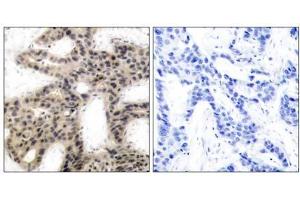 Immunohistochemical analysis of paraffin-embedded human breast carcinoma tissue using 4E-BP1 (phospho-Thr45) antibody (E011223). (eIF4EBP1 Antikörper  (pThr45))