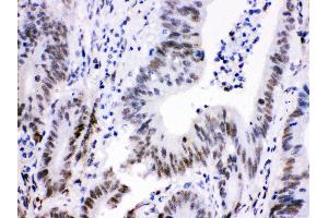 Anti- Cdk9 Picoband antibody, IHC(P) IHC(P): Human Intestinal Cancer Tissue (CDK9 Antikörper  (AA 141-372))