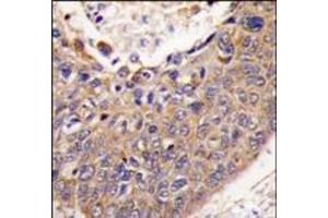 Formalin-fixed and paraffin-embedded human lung carcinoma tissue reacted with FXN antibody (C-term), which was peroxidase-conjugated to the secondary antibody, followed by DAB staining. (Frataxin Antikörper  (C-Term))