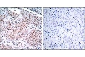 Immunohistochemistry analysis of paraffin-embedded human breast carcinoma, using Estrogen Receptor-alpha (Phospho-Ser104) Antibody. (Estrogen Receptor alpha Antikörper  (pSer104))