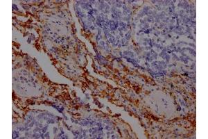 IHC image of ABIN7127559 diluted at 1:100 and staining in paraffin-embedded human lung cancer performed on a Leica BondTM system. (Rekombinanter ICAM1 Antikörper)