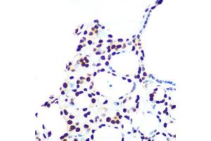 Immunohistochemistry of paraffin-embedded human thyroid cancer using hnRNP U Rabbit mAb (ABIN1679689, ABIN3018741, ABIN3018742 and ABIN7101656) at dilution of 1:100 (40x lens). (HNRNPU Antikörper)