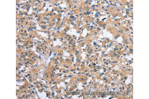 Immunohistochemistry of Human thyroid cancer using PAK2 Polyclonal Antibody at dilution of 1:40 (PAK2 Antikörper)