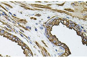 Immunohistochemistry of paraffin-embedded Human prostate using FLNB Polyclonal Antibody at dilution of 1:100 (40x lens). (FLNB Antikörper)