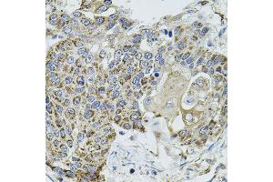 Immunohistochemistry of paraffin-embedded human lung cancer using VEPH1 antibody (ABIN5974616) (40x lens). (VEPH1 Antikörper)