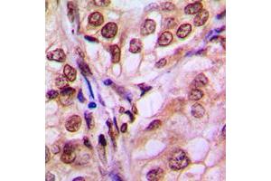 Immunohistochemical analysis of 4EBP1 staining in human breast cancer formalin fixed paraffin embedded tissue section. (eIF4EBP1 Antikörper  (Center))