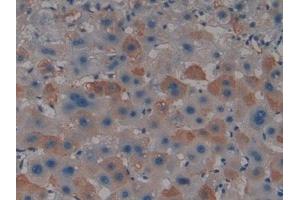Detection of PADI4 in Human Liver cancer Tissue using Polyclonal Antibody to Peptidyl Arginine Deiminase Type IV (PADI4) (PAD4 Antikörper  (AA 1-300))