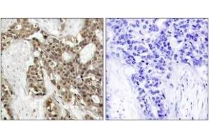 Immunohistochemistry analysis of paraffin-embedded human breast carcinoma, using p44/42 MAP Kinase (Phospho-Tyr204) Antibody. (ERK1/2 Antikörper  (pTyr204))