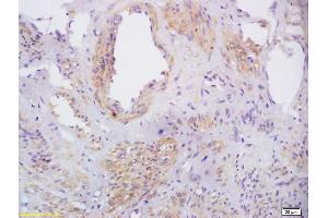 Formalin-fixed and paraffin embedded human cervical carcinoma labeled with Rabbit Anti phospho-CXCR4(Ser339) Polyclonal Antibody, Unconjugated (ABIN1714582) at 1:200 followed by conjugation to the secondary antibody and DAB staining (CXCR4 Antikörper  (pSer339))