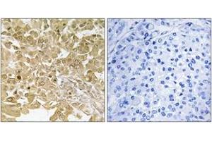 Immunohistochemistry analysis of paraffin-embedded human breast carcinoma tissue, using MEK1 (Ab-291) Antibody. (MEK1 Antikörper  (AA 261-310))