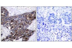 Immunohistochemical analysis of paraffin-embedded human breast carcinoma tissue using Connexin43 (phospho-Ser367) antibody (E011258). (Connexin 43/GJA1 Antikörper  (pSer367))