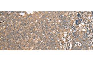 Immunohistochemistry of paraffin-embedded Human cervical cancer tissue using ECI1 Polyclonal Antibody at dilution of 1:30(x200) (DCI Antikörper)