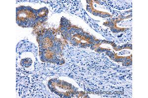 Immunohistochemistry of Human colon cancer using STAT5A Polyclonal Antibody at dilution of 1:25 (STAT5A Antikörper)