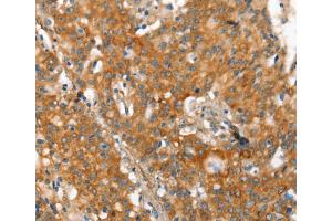 Immunohistochemistry (IHC) image for anti-Matrix Metalloproteinase 2 (MMP2) antibody (ABIN2434292) (MMP2 Antikörper)