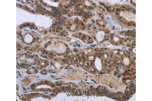 Immunohistochemistry of Human thyroid cancer using GGCX Polyclonal Antibody at dilution of 1:50 (GGCX Antikörper)