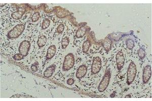 Immunohistochemistry of paraffin-embedded Human colon carcinoma tissue using HDAC1 Monoclonal Antibody at dilution of 1:200. (HDAC1 Antikörper)