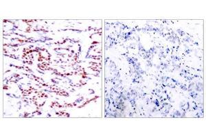 Immunohistochemical analysis of paraffin-embedded human breast carcinoma tissue using ATF-2 (phospho-Thr71 or 53) antibody (E011031). (ATF2 Antikörper  (pThr53, pThr71))