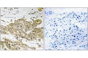 Immunohistochemistry (IHC) image for anti-Tumor Protein P53 (TP53) (pSer6) antibody (ABIN2888502) (p53 Antikörper  (pSer6))