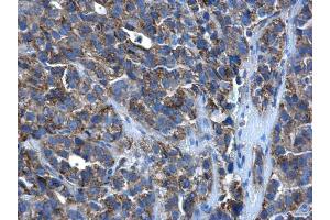 IHC-P Image PEX26 antibody detects PEX26 protein at cytoplasm in human cervical cancer by immunohistochemical analysis. (PEX26 Antikörper)