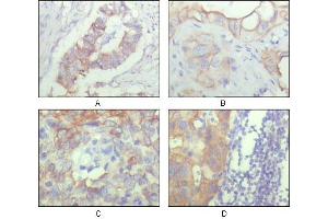 Immunohistochemical analysis of paraffin-embedded human ovary carcinoma (A), kidney carcinoma (B), lung carcinoma (C) and breast carcinoma (D), showing cytoplasmic and membrane localization with DAB staining using ALCAM mouse mAb. (CD166 Antikörper)