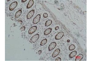 Immunohistochemistry (IHC) analysis of paraffin-embedded Human Colon Carcicnoma using HSP90 alpha Mouse Monoclonal Antibody diluted at 1:200. (HSP90AA2 Antikörper)