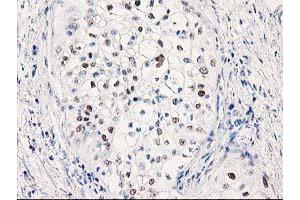 Immunohistochemical staining of paraffin-embedded Carcinoma of Human pancreas tissue using anti-TP53 mouse monoclonal antibody. (p53 Antikörper)