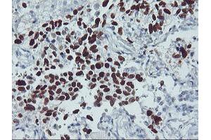 Immunohistochemical staining of paraffin-embedded Carcinoma of Human lung tissue using anti-TP53 mouse monoclonal antibody. (p53 Antikörper)