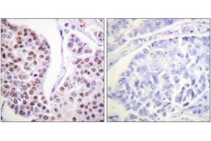 Immunohistochemistry analysis of paraffin-embedded human breast carcinoma tissue, using Histone H4 (Ab-8) Antibody. (Histone H4 Antikörper  (AA 6-55))