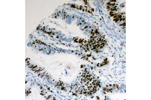 Immunohistochemical analysis of Cyclin E1 (pT395) staining in human colon cancer formalin fixed paraffin embedded tissue section. (Cyclin E1 Antikörper  (C-Term, pSer395))