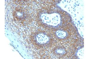 Formalin-fixed, paraffin-embedded human Cervical Squamous Cell Carcinoma stained with CD44v4 Mouse Monoclonal Antibody (CD44v4/1219) (CD44 Antikörper)