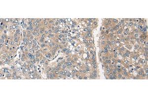 Immunohistochemistry of paraffin-embedded Human liver cancer tissue using CLIC6 Polyclonal Antibody at dilution of 1:40(x200) (CLIC6 Antikörper)