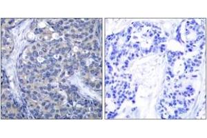 Immunohistochemistry analysis of paraffin-embedded human breast carcinoma tissue, using ZAP-70 (Ab-319) Antibody. (ZAP70 Antikörper  (AA 286-335))