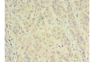 Immunohistochemistry of paraffin-embedded human liver cancer using ABIN7143935 at dilution of 1:100 (NAPA Antikörper  (AA 1-295))