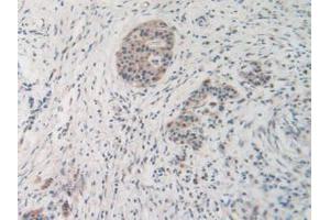 IHC-P analysis of Human Pancreas Cancer Tissue, with DAB staining. (MMP19 Antikörper  (AA 98-508))