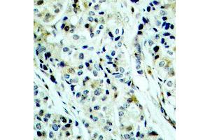 Immunohistochemistry of paraffin-embedded human breast carcinoma using Phospho-HDAC5-S498 antibody (ABIN2987596). (HDAC5 Antikörper  (pSer498))