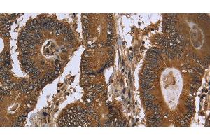 Immunohistochemistry of paraffin-embedded Human colon cancer using FGFRL1 Polyclonal Antibody at dilution of 1:40 (FGFRL1 Antikörper)