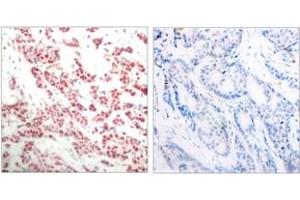 Immunohistochemistry analysis of paraffin-embedded human breast carcinoma, using NF-kappaB p100/p52 (Phospho-Ser865) Antibody. (NFKB2 Antikörper  (pSer866))