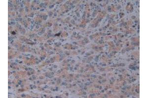 IHC-P analysis of Human Prostate Gland Cancer Tissue, with DAB staining. (Fibrillin 1 Antikörper  (AA 246-389))