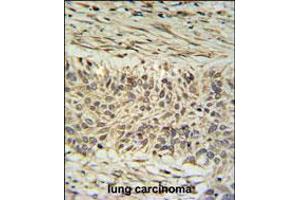 DDX23 Antibody IHC analysis in formalin fixed and paraffin embedded lung carcinoma followed by peroxidase conjugation of the secondary antibody and DAB staining. (DDX23 Antikörper  (AA 248-277))