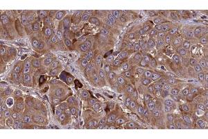 ABIN6273838 at 1/100 staining Human liver cancer tissue by IHC-P. (HTR3E Antikörper  (Internal Region))