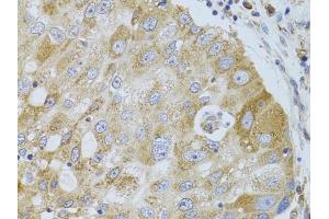 Immunohistochemistry of paraffin-embedded human breast cancer using HD antibody (ABIN6128014, ABIN6141689, ABIN6141690 and ABIN7101785) at dilution of 1:100 (40x lens). (HDAC8 Antikörper  (AA 1-377))